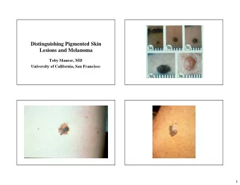 Distinguishing Pigmented Skin  Lesions and Melanoma  Toby Maurer, MD  University of California, San