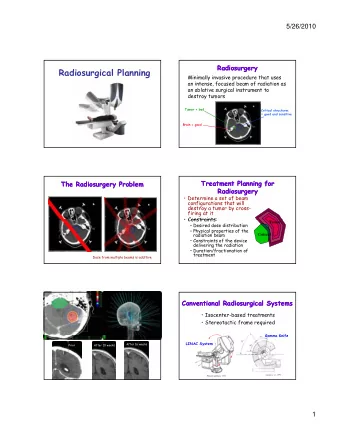 Radiosurgical Planning  Minimally invasive procedure that uses  an intense, focused beam of