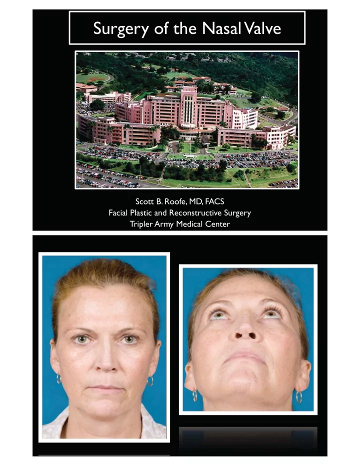 surgery of the nasal valve