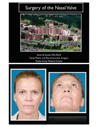 Surgery of the Nasal Valve  Scott B. Roofe, MD, FACS  Facial Plastic and Reconstructive Surgery