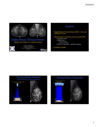 Outline    Digital Breast Tomosynthesis (DBT)  the new  standard of care    Breast cancer
