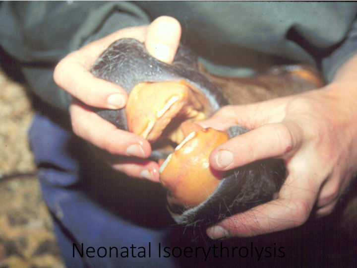 neonatal isoerythrolysis neonatal isoerythrolysis