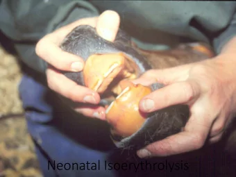 Neonatal Isoerythrolysis  Neonatal Isoerythrolysis  Pathogenesis  Immune mediated hemolytic