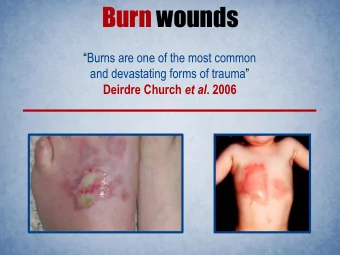 Burn wounds  Burns are one of the most common and devastating forms of trauma  Deirdre Church