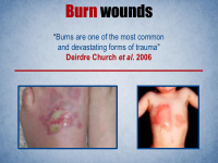 burn wounds