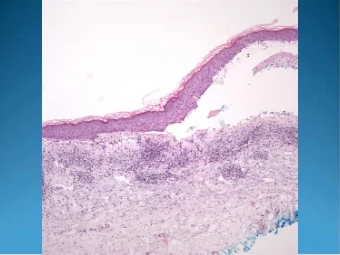 Bullous Pemphigoid  Pearls  Cell rich or cell poor  subepidermal bullae  Eosinophils