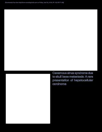 Cavernous sinus syndrome due Kalyan B. Bhattacharyya, Saurabh Rai 1  to skull base metastasis: A